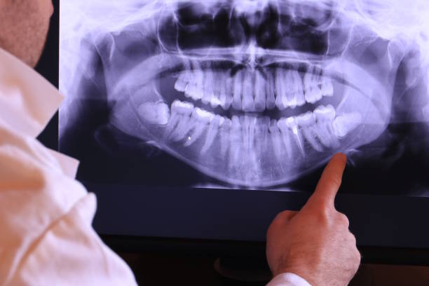 Best Emergency Dentist for Lost Fillings or Crowns in Smithsburg, MD